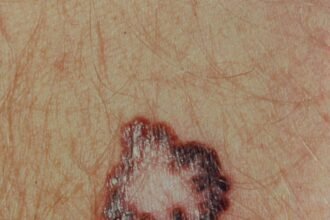 The Impact of Mohs Skin Cancer Surgery on Patient Quality of Life