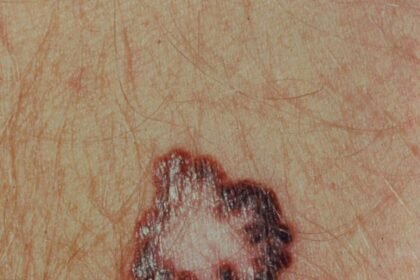 The Impact of Mohs Skin Cancer Surgery on Patient Quality of Life