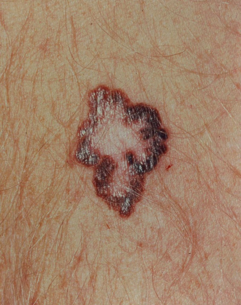 The Impact of Mohs Skin Cancer Surgery on Patient Quality of Life