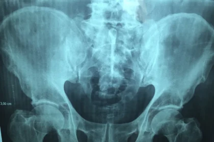 Understanding the Causes and Treatments for Chronic Hip Pain