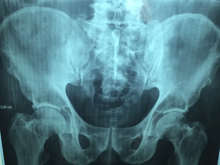 Understanding the Causes and Treatments for Chronic Hip Pain