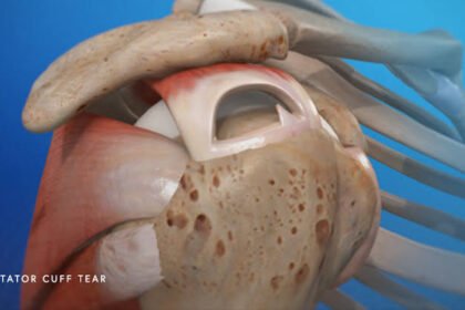 Understanding the Long-Term Effects of a Rotator Cuff Tear