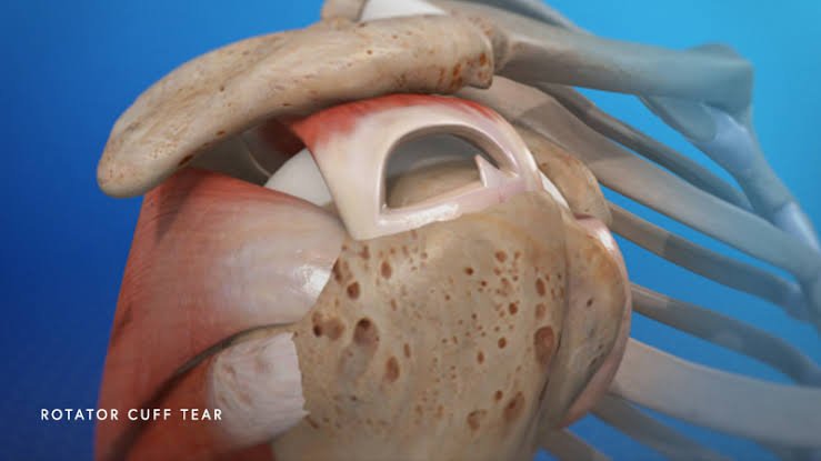 Understanding the Long-Term Effects of a Rotator Cuff Tear