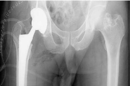 Exploring the Effectiveness of Hip Replacement Surgery