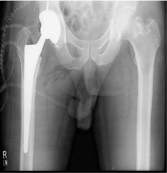Exploring the Effectiveness of Hip Replacement Surgery