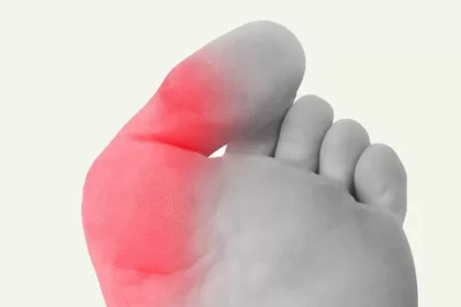 How Bunions Develop and Their Impact on Daily Life