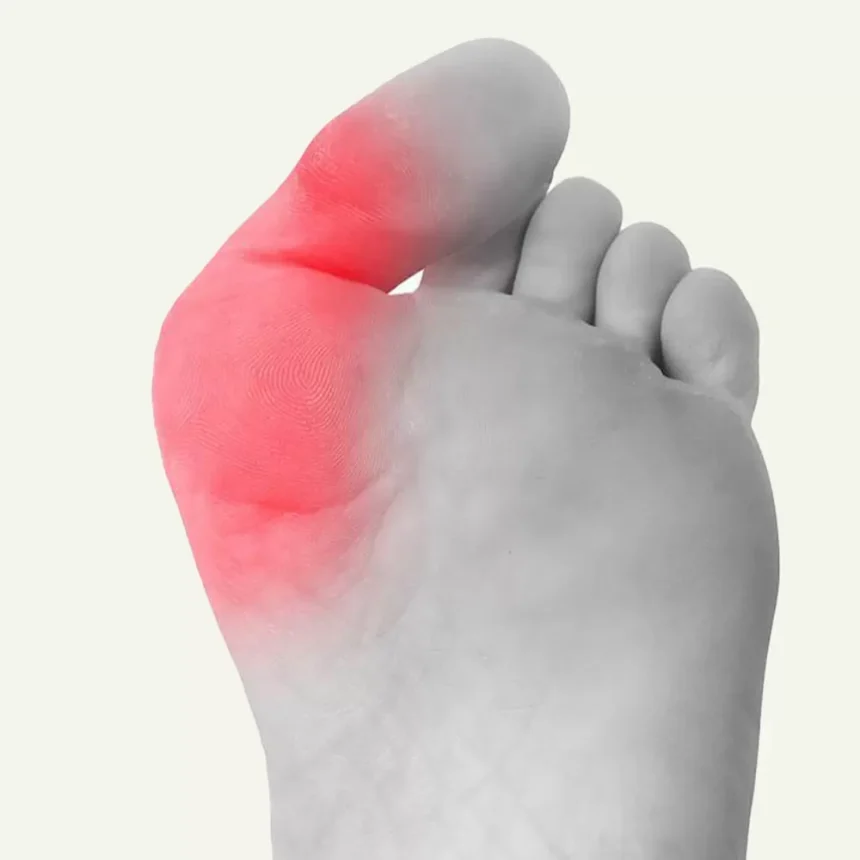 How Bunions Develop and Their Impact on Daily Life