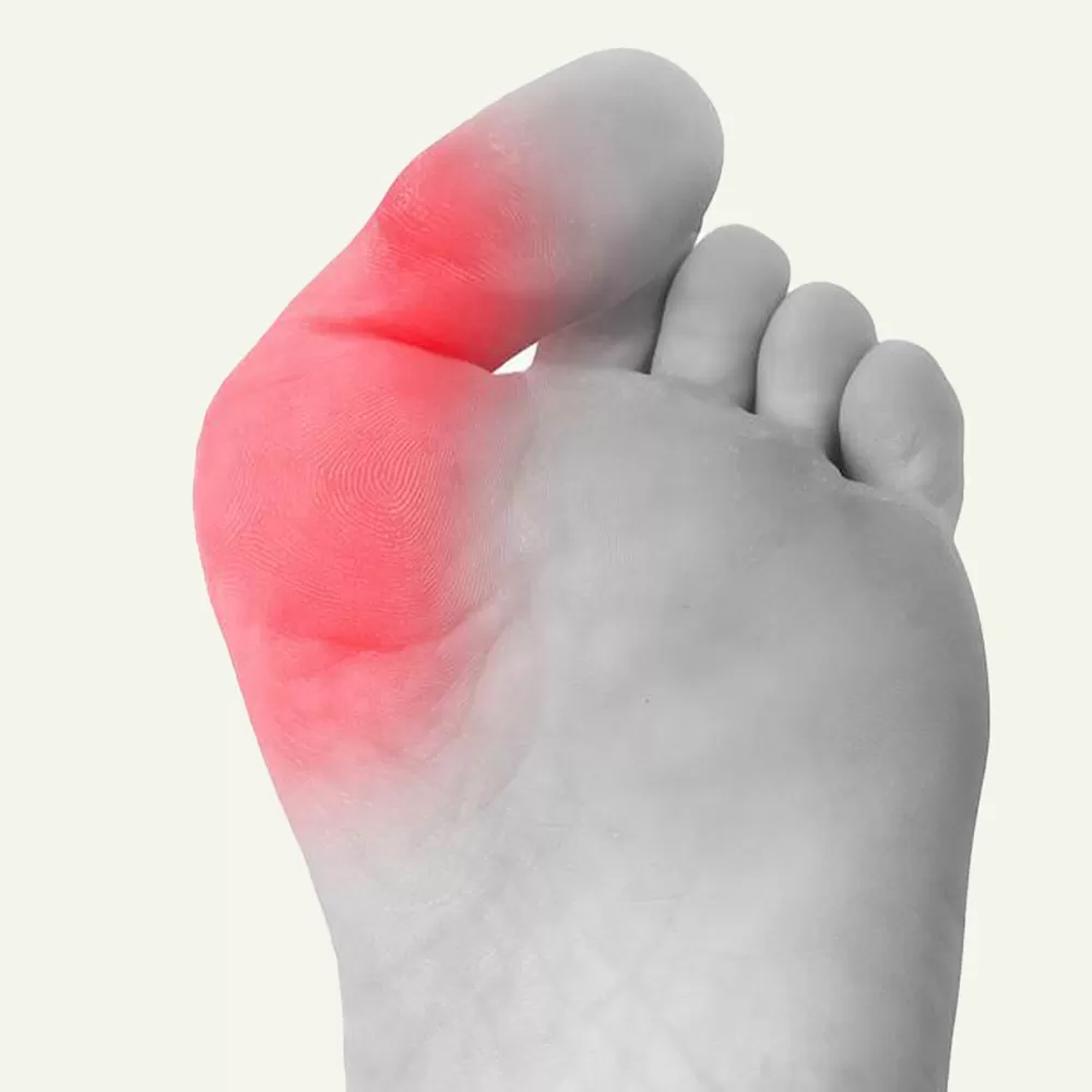 How Bunions Develop and Their Impact on Daily Life