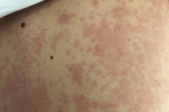 Recognizing Drug Allergies in Children