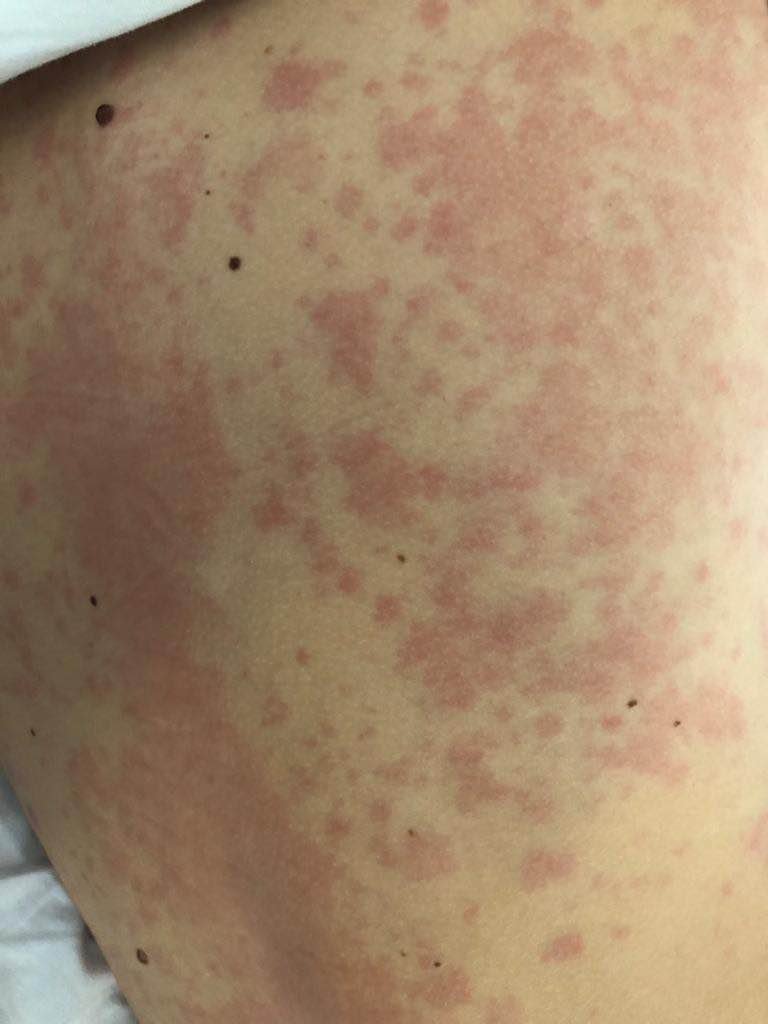 Recognizing Drug Allergies in Children