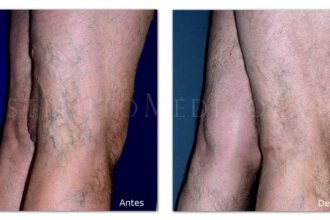Sclerotherapy Versus Other Treatments