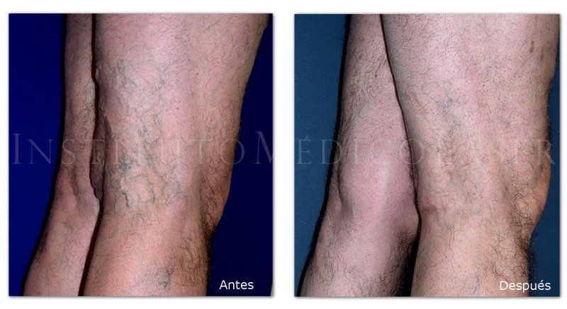 Sclerotherapy Versus Other Treatments