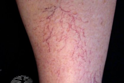 Understanding the Psychological Effects of Spider Veins