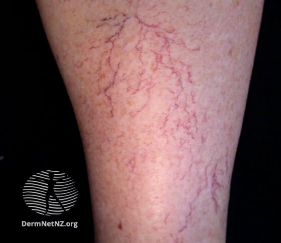 Understanding the Psychological Effects of Spider Veins